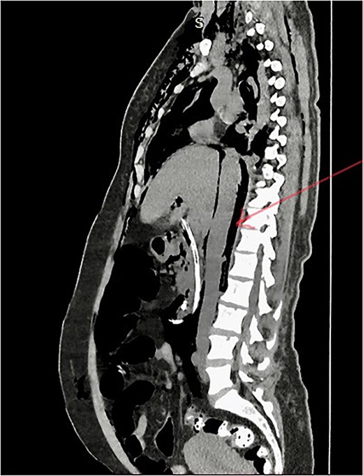 Post-ERCP NCCT abdomen shows pneumo-retroperitoneum (red arrow).