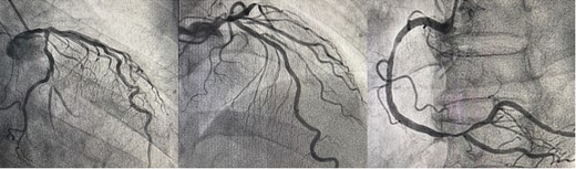 This coronary angiography indicates triple-vessel coronary artery disease. (LMT: 50% stenosis, LAD proximal: 90% stenosis, OM2: 80% stenosis, RCA distal: 90% stenosis)