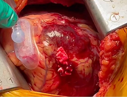 We observed an epicardial hematoma at apex of the left ventricular when we detached one of the Tentacles NEO suction cups.