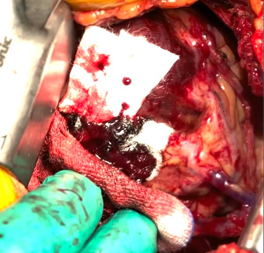 The bleeding spot was repaired using a continuous suture with 4–0 prolene and two large felts. Following the administration of protamine, effective hemostasis was achieved.
