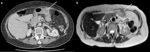 CT and MRI of the lesion (arrows). (a) CT showed a 32 mm cystic enhancing lesion between the anterior abdominal wall and mid greater curvature of the stomach. (b) The lesion appeared hyperintense on T2 imaging and predominantly isointense on T1 imaging, without significant internal debris.