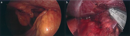Laparoscopic images. (a) Tumor with a broad base on the anterior abdominal wall and apex adherent to the greater curvature of the stomach inferiorly. (b) Partial gastrectomy for clearance of margins, following tumor excision.