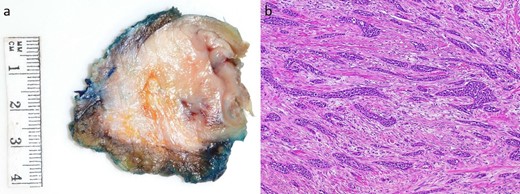 Macroscopic and microscopic appearance of the tumor. (a) A 33 × 30 mm mural tumor. (b) Hematoxylin and oesin (HE) stain at 40× magnification showing invasive ductal adenocarcinoma with prominent desmoplastic stroma.