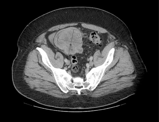 Initial CT imaging, axial cut, showing necrotic mass causing small bowel obstruction.