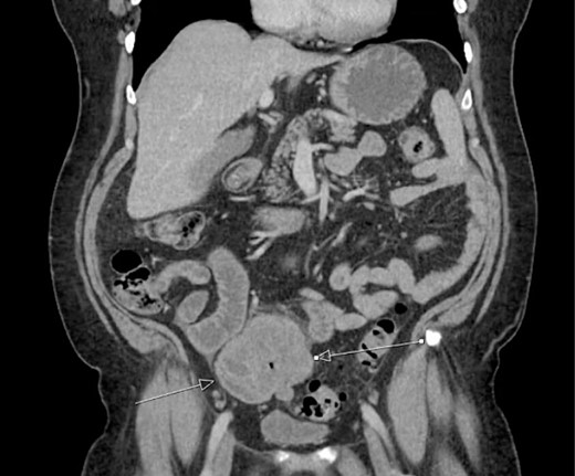 Initial CT imaging, coronal cut, showing necrotic mass causing small bowel obstruction.