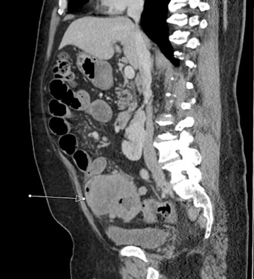 Initial CT imaging, sagittal cut, showing necrotic mass causing small bowel obstruction.