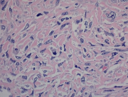 400× magnification. Hematoxylin and eosin stain of tumor cells showing mitotic figures.