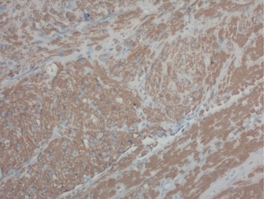 200× magnification of tumor cells. Immunohistochemical stain for smooth muscle actin is positive.