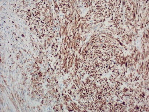 200× magnification of tumor cells. Immunohistochemical stain for desmin is positive.