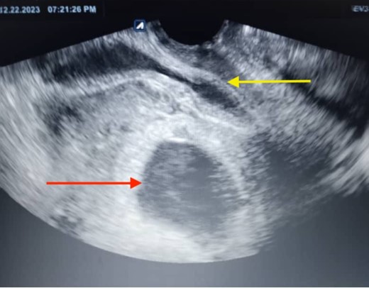 The ultrasonographic imaging conducted the day following the patient’s hospital admission revealed a ruptured gestational sac (the lower arrow), which was apparent outside the uterus. The uterine mass was visible on one side (the upper arrow), and the gestational mass was on the other side.