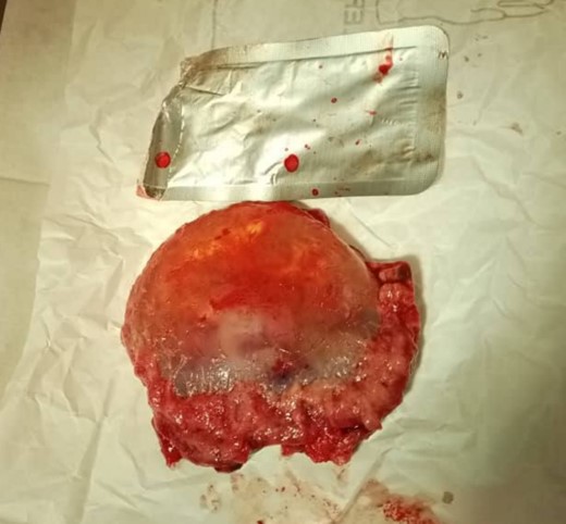 The extracted gestational sac at the end of the surgical procedure.