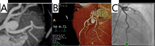 (A, B) Cardiac CTA showing a saccular aneurysm measuring 12.5 mm in length from the LMCA bifurcation to the apex of the aneurysm, and 9.04 × 10.5 mm in cross-sectional area. (C) LHC showing a distal LMCA aneurysm between the LAD and left circumflex.