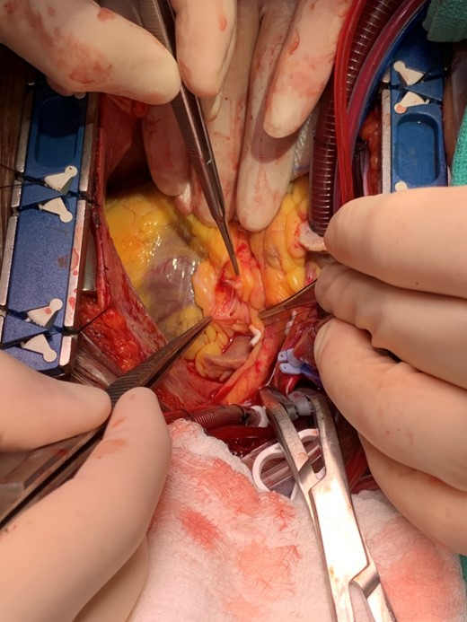 Intraoperative photo demonstrating the lumen of the distal left main coronary artery where it bifurcates into the circumflex and left anterior descending artery through the incised superior wall of the aneurysm.