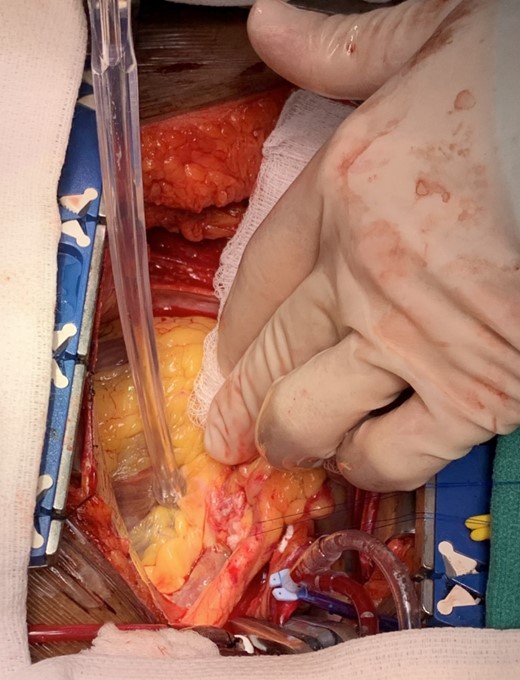 Intraoperative photo demonstrating the patch repair of the left main coronary artery aneurysm.
