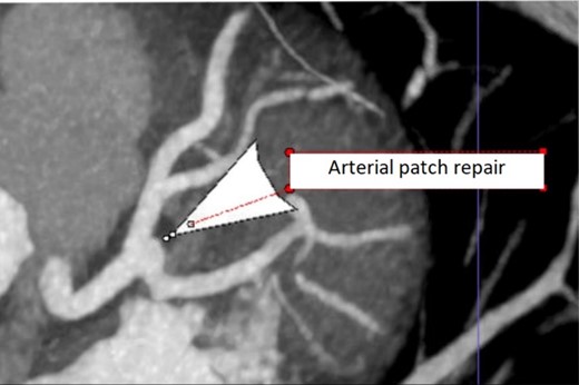 Repeat coronary CTA at 3 month follow up showing normal appearing distal LMCA.