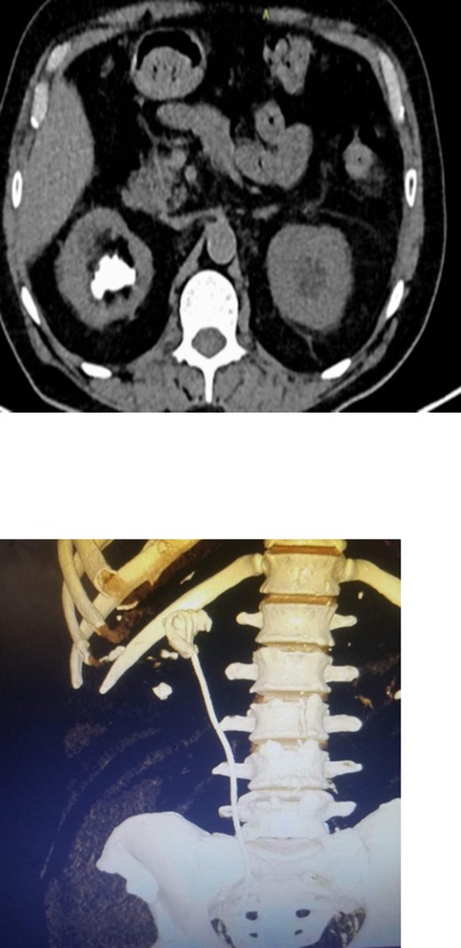 Non-contrast CT scan showed intra-renal stone with significant proximal pigtail calcification and mild degree of hydronephrosis.