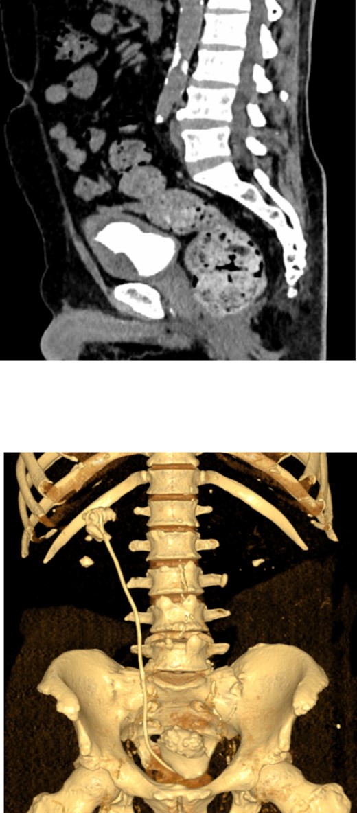 Non-contrast CT scan showed giant bladder stone profoundly embedded in the distal pigtail of the DJ stent.