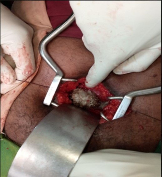 (A) An intraoperative view of the bladder stone as it was seen after the bladder opened anteriorly. (B) The appearance of the bladder stone after removal with the distal segment of the DJ stent.