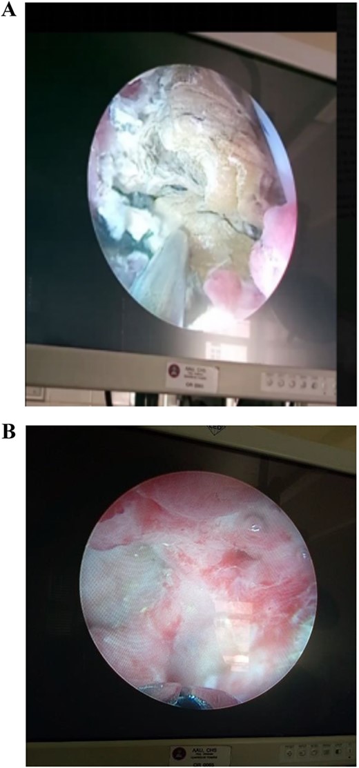 (A) An intraoperative view showing the intra-renal stone being fragmented by pneumatic lithotripsy. (B) Nephroscopic view of calyceal system cleared of the stones.