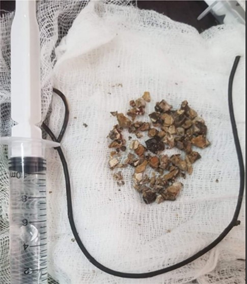 Post-operative appearance of the removed encrusted and the intra-renal stone fragments.