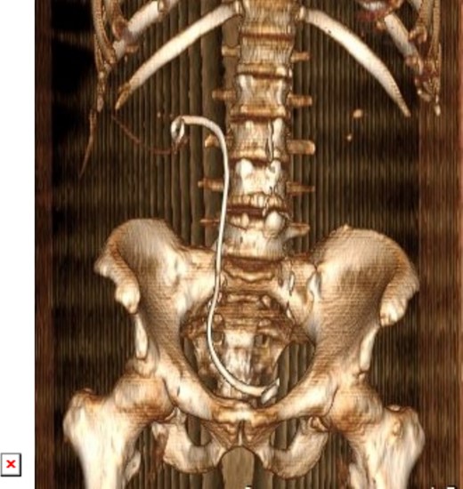 3D constructed image of postoperative low dose non-contrast CT scan showing stone clearance and newly inserted DJ stent in-situ.
