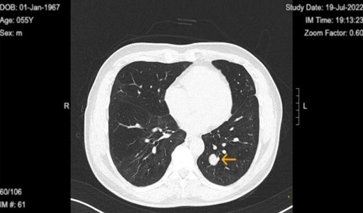 Chest computed tomography in 2022 revealed well circumscribed solitary lung tumor of 1.5 × 1.3 cm in size.