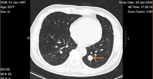 Chest computed tomography in 2024 shows well circumscribed solitary lung tumor of 1.9 × 1.6 cm in size.