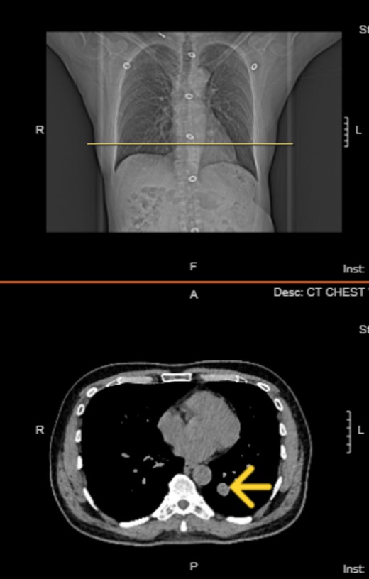 Top image: Coronal view indicating the level of the solitary fibrous tumor (SFT). Bottom image: Axial CT scan at the indicated level, showing a well-circumscribed, homogeneous mass.