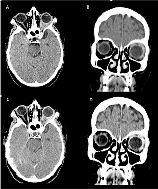 Axial and coronal cerebral CT scans show enlargement of the left lateral and superior rectal muscles (A–B), with slight enhancement (C–D).