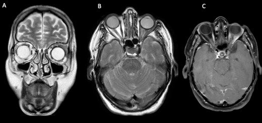 Cerebral and orbital MRI. (A–B) Coronal and axial T2-weighted MRI show iso-intense thickening of the left lateral and superior rectal muscles with fat atrophy. (C) Axial T1-weighted MRI with gadolinium enhancement and fat suppression reveals slight enhancement of the left lateral and superior rectal muscles with infiltration of the surrounding tissues.