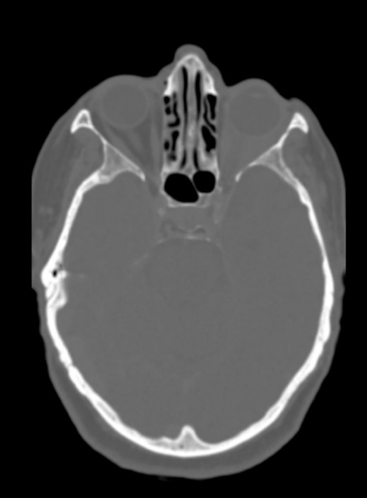 No cranial bone lesions were detected.