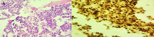 Histopathologic examination of left orbital biopsy specimen. (A) HE stain (×200) tumor cells infiltrating striated muscle fibers. (B) Immunohistochemistry: ER (×200) diffuse and strong nuclear staining.
