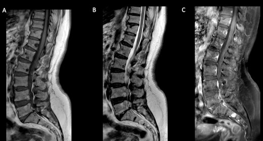 Spine MRI. Sagittal T1 (A) and T2 (B) reveal multiple hypo-intense vertebral metastases with enhancement (C).