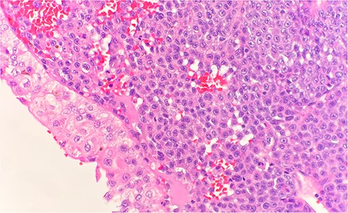 Microscopic examination reveals sheets of round cell beneath unremarkable urothelium epithelium. H&E stain 40×.