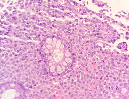 Microscopic examination reveals sheets of round cell between unremarkable colonic crypts. H&E stain 40×.