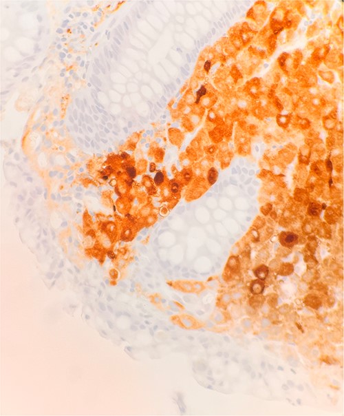 Microscopic examination reveals sheets of round are positive for S100. IHC stain 40×.