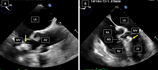 Panel A. Mid-esophageal aortic valve long-axis view, tumor’s relation to the aortic valve is demonstrated. Panel B. Mid-esophageal four-chamber view, tumor’s relation to the mitral valve and the interventricular septum is demonstrated. Arrows point to tumor, LA = left atrium, MV = mitral valve, AV = aortic valve, RA = right atrium, MS = membranous septum, RV = right ventricle, LV = left ventricle.