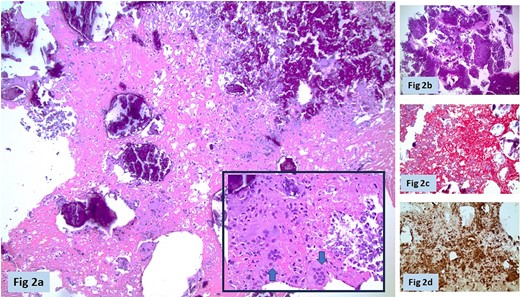 Histopathology. (a) Organizing eosinophilic fibrinoid material with calcific deposits (dark hematoxyphilic debris) × 100 magnification hematoxylin and eosin (H&E) stain. Inset shows granulomatous reaction with multinucleate giant cells (arrows), and histiocytes (highlighted by CD68 immunostain in Fig. 2d). (b) Dense calcific debris in other fragments obscuring underlying tissue (×40 H&E). (c) Masson trichrome stain supporting brick red fibrinous background (×200). (d) CD68 immunostain highlighting histiocyte-macrophage infiltrates (×200).