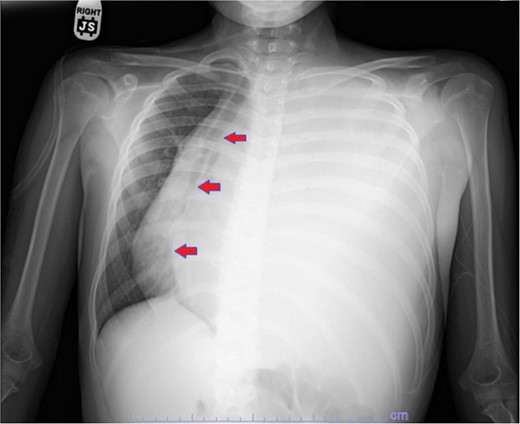 Plain film showing complete left hemithorax opacification and mediastinal shift (arrows) to right.