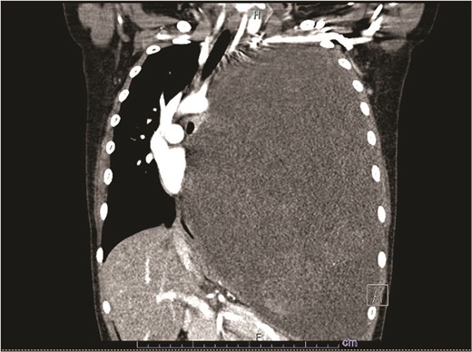 CT imaging depicting extent of mass.