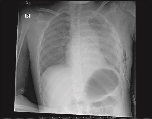 Plain film on postoperative day 0 depicting the recovery of the left lung post-surgical resection.