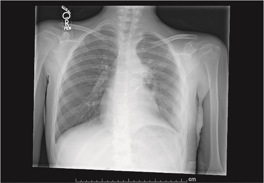 Plain film postoperative day 5, after removal of chest tube, showing improving pulmonary status in the left hemithorax.