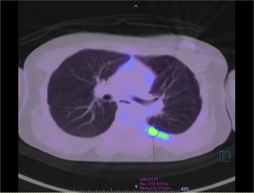 PET/CT showing residual hypermetabolic focus at plural resection margin, concerning for residual disease.