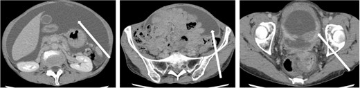 CT findings. In addition to significant ascites accumulation, there was a partial bowel obstruction-like finding.