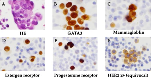 Histopathological findings. (A) HE staining showed a high N/C ratio, nuclear enlargement, and the appearance of solitary, scattered to small clusters of malignant cells of distinct glandular origin, suggesting an adenocarcinoma origin. (B) Cell block was positive for GATA3. (C) Cell block was positive for mammaglobin. (D) Positive immunohistochemistry for estrogen receptor. (E) Positive immunohistochemistry for progesterone receptor. (F) Immunohistochemistry showed HER2 was 2+ and no amplification by FISH.