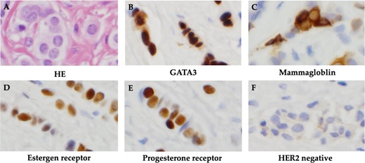Histopathological findings. (A) HE staining showed atypical cells with rounded, slightly irregularly sized nuclei and chromatin-delicate nuclei with linear infiltration and proliferation. (B) Cell block was positive for GATA3. (C) Cell block was positive for mammaglobin. (D) Positive immunohistochemistry for estrogen receptor. (E) Positive immunohistochemistry for progesterone receptor. (F) Negative immunohistochemistry for HER2.