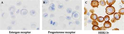 Histopathological findings. (A) Negative immunohistochemistry for estrogen receptor. (B) Negative immunohistochemistry for progesterone receptor. (C) Positive immunohistochemistry for HER2.