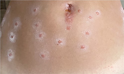 Lower abdomen with multiple scattered, roughly 1 cm, discreet well-circumscribed shiny papules with border of ill-defined ashy scale arranged in parallel vertical lines in locations of needle injection of tumescent solution inserted through skin coated with CHD.