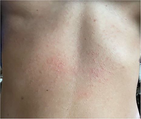 Upper abdomen with Ill-defined and erythematous eczematous papules coalescing into a poorly marginated thin plaque with mild background erythema.