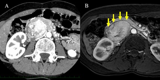 CT scan and MRI. (A) The hypervascular tumor was located dorsal to the pancreatic head in the arterial phase of contrast-enhanced CT scan. However, the outline of the tumor adjacent to the pancreas was somewhat unclear. (B) Fat-saturated T1-weighted MRI showing a clear plane between the tumor and pancreas.